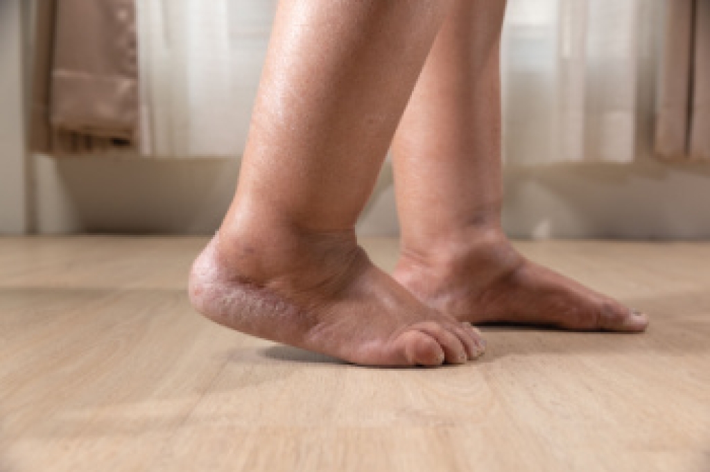 Causes of Swollen Feet and Ankles