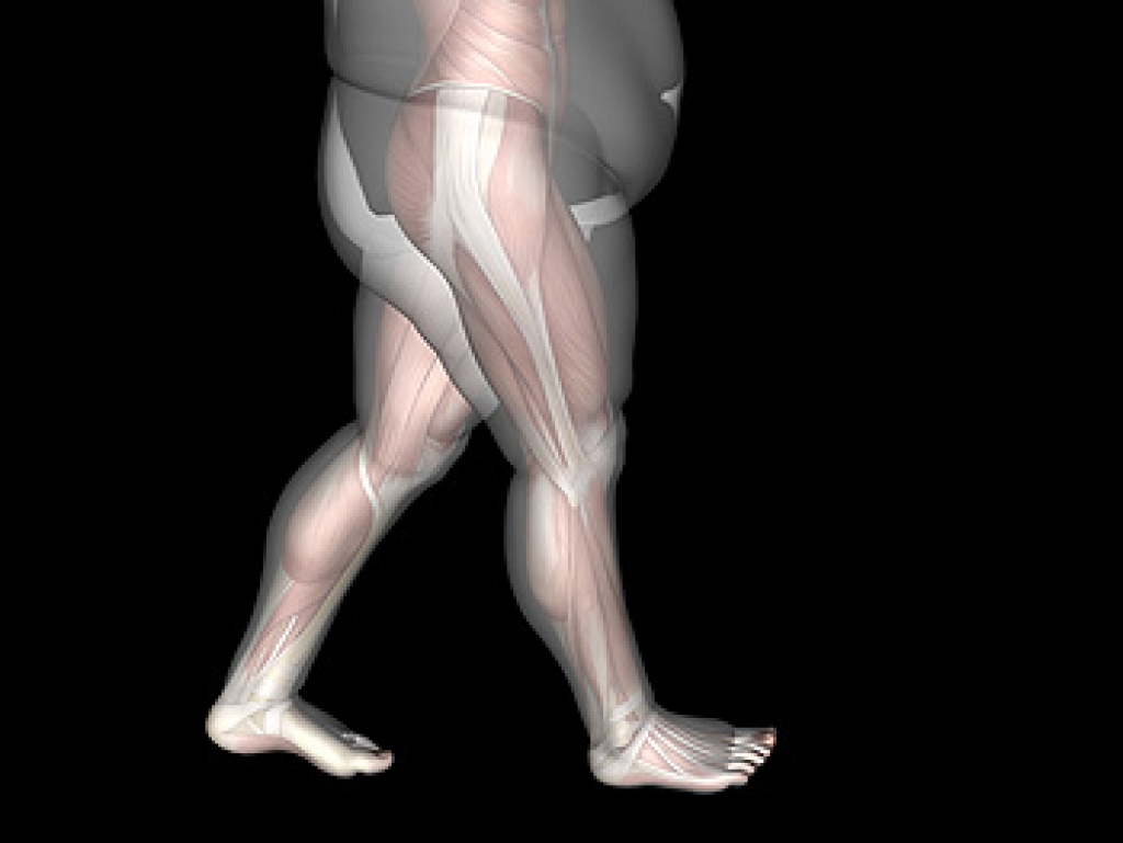 Obesity May Lead to Medical Conditions That Affect the Feet