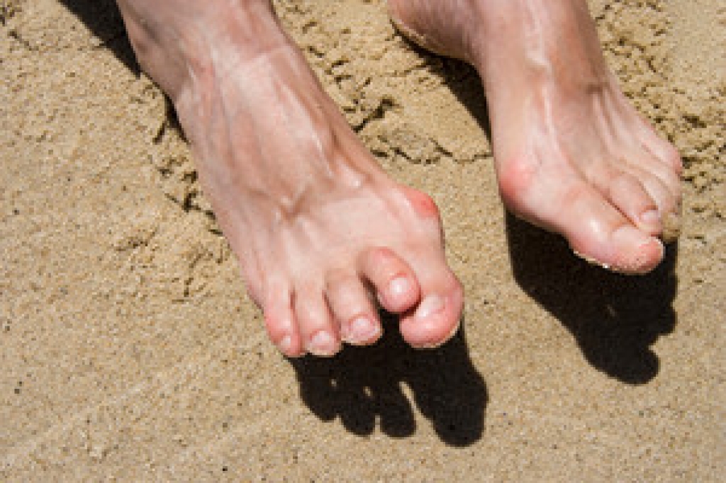 Why Do Hammertoes Develop?