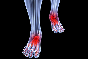 arthritic foot care in the Nassau County, NY: Massapequa (Hempstead, Levittown, Wantagh, East Meadow, Merrick, North Bellmore, Roosevelt, Bellmore, South Farmingdale, North Merrick) and Sufolk County, NY: West Babylon, Lindenhurst, Copiague, North Amityville areas