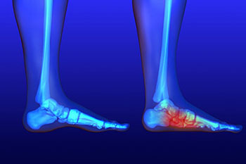 flat feet treatment in the Nassau County, NY: Massapequa (Hempstead, Levittown, Wantagh, East Meadow, Merrick, North Bellmore, Roosevelt, Bellmore, South Farmingdale, North Merrick) and Sufolk County, NY: West Babylon, Lindenhurst, Copiague, North Amityville areas