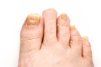toenail fungus treatment in the Nassau County, NY: Massapequa (Hempstead, Levittown, Wantagh, East Meadow, Merrick, North Bellmore, Roosevelt, Bellmore, South Farmingdale, North Merrick) and Sufolk County, NY: West Babylon, Lindenhurst, Copiague, North Amityville areas