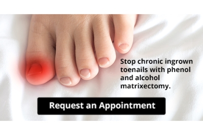Stop Chronic Ingrown Toenails with Phenol and Alcohol Matrixectomy