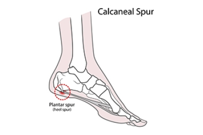 Are Heel Spurs Causing Your Heel Pain?