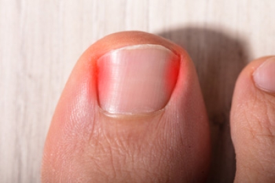 Relieving Pain From Ingrown Toenails With Gutter Splints