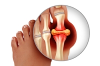 Understanding Gout