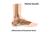 Simple Relief Techniques for Plantar Fasciitis