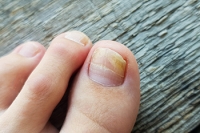 What You Need to Know About Toenail Fungus