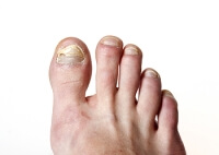 Causes and Symptoms of Toenail Fungus