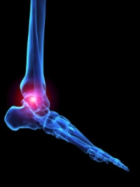 The Pain in Your Ankle May Be Arthritis