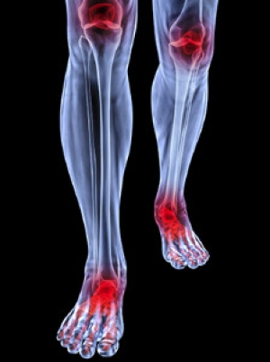 What Is Juvenile Arthritis?