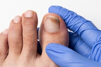 Treating Toenail Fungus