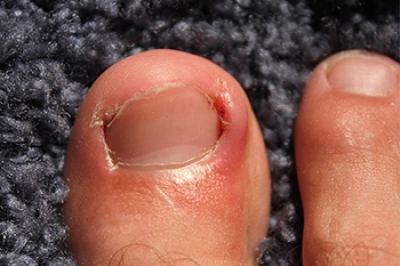 Painful Ingrown Toenails