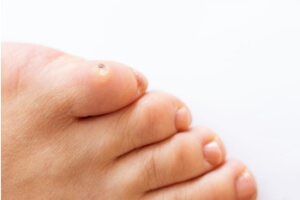Professional Removal of Corns