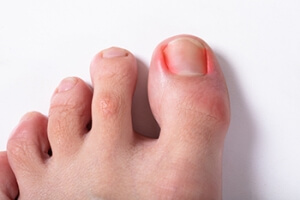 When an Ingrown Toenail Is Infected