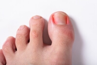 When an Ingrown Toenail Is Infected
