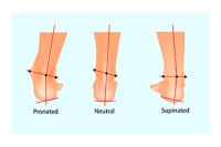 Causes of Overpronation