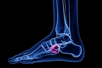 Symptoms Associated With Cuboid Syndrome