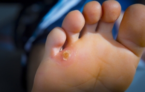How Are Foot Corns Treated?
