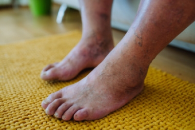 Protecting Your Feet When You Have Diabetes