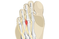 Constricting Shoes May Cause Morton’s Neuroma