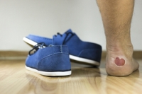 Eczema May Cause Blisters on the Feet